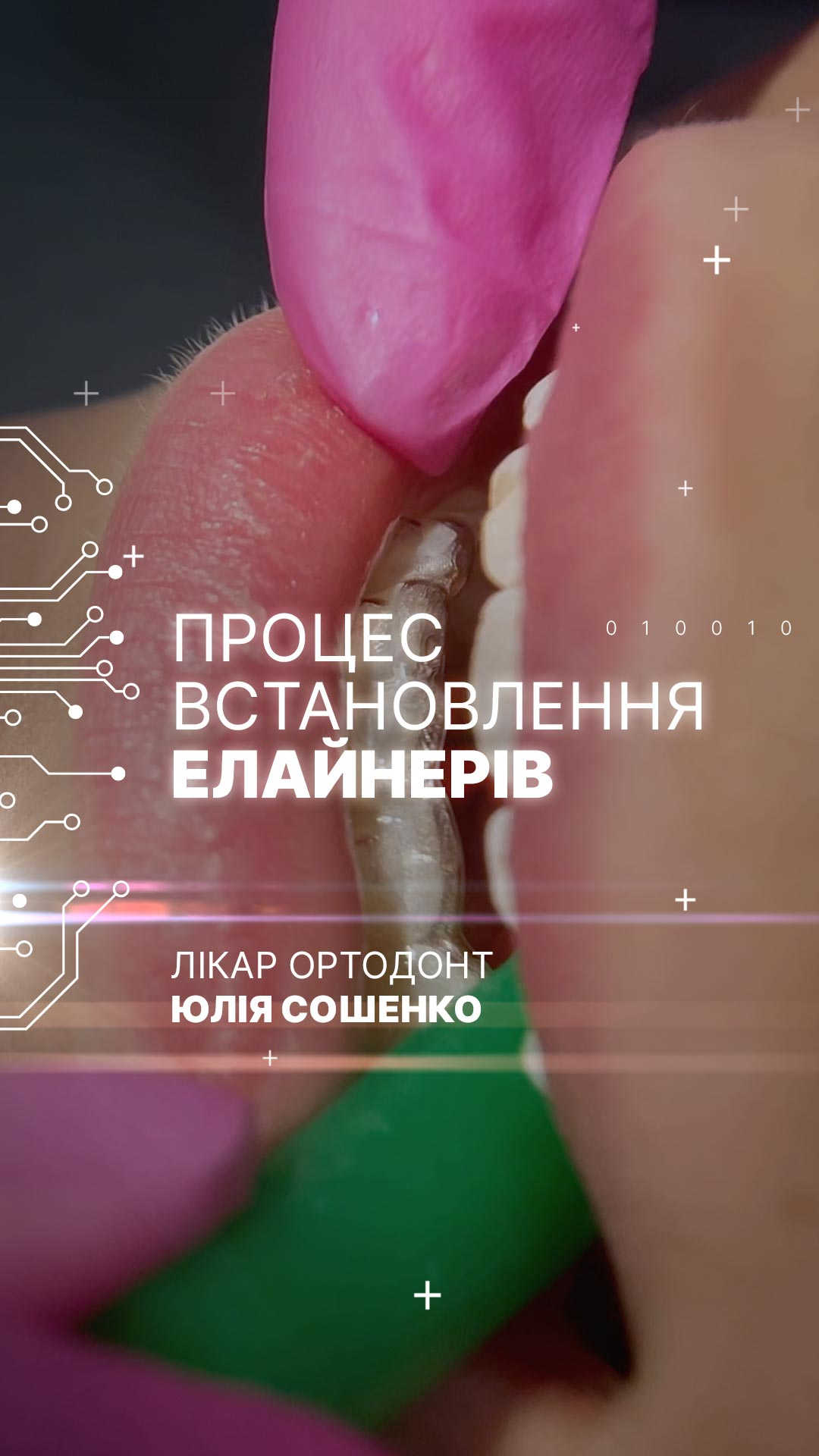 Фото: Вирівнювання зубів елайнерами Invisalign № 23 | Nozenko