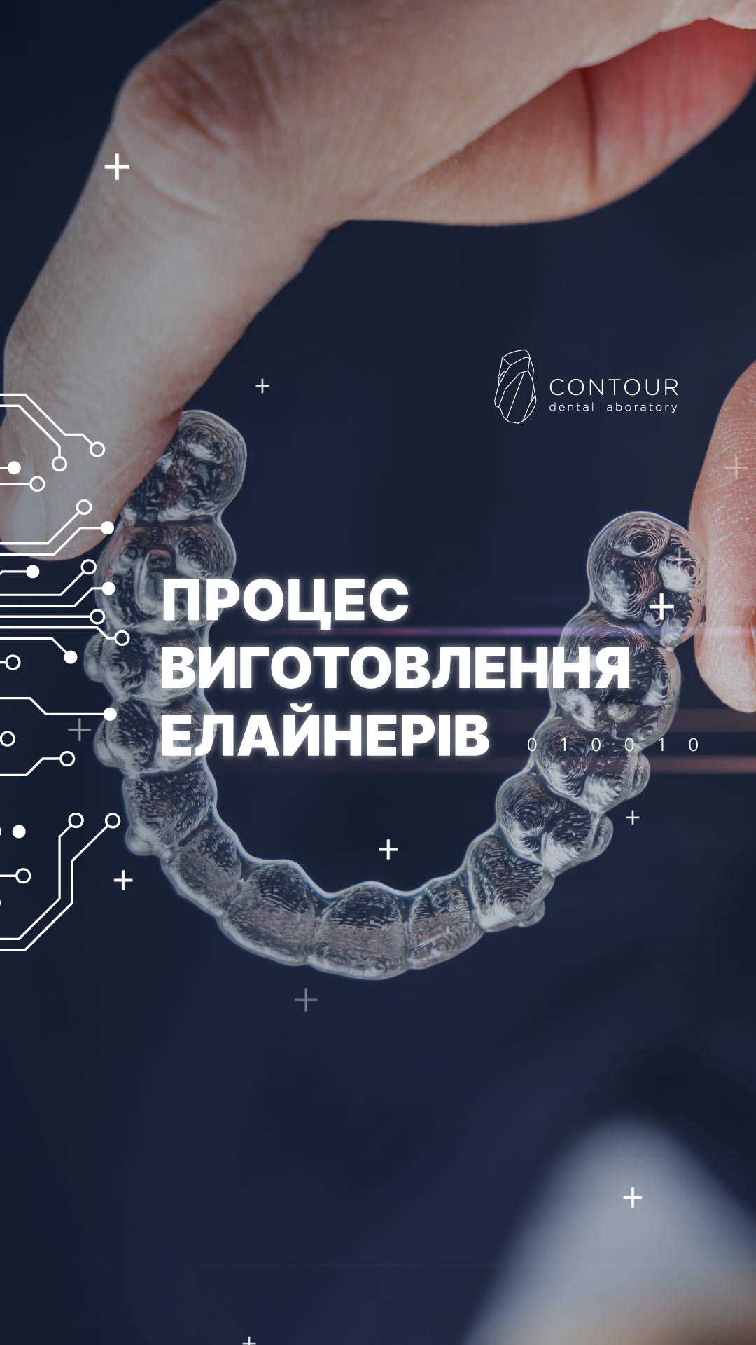 Фото: Вирівнювання зубів елайнерами Invisalign № 26 | Nozenko